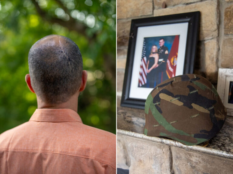 During William Wilcox's service in the Marines, he fired heavy weapons, including shoulder-mounted missile launchers. The blast waves from those weapons may have led to an arteriovenous malformation (AVM) in his brain. As a result of the malformation and subsequent surgery, he now has epilepsy, memory problems, and other symptoms.