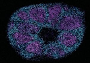 Scientists map key protein interactions linked with profound autism